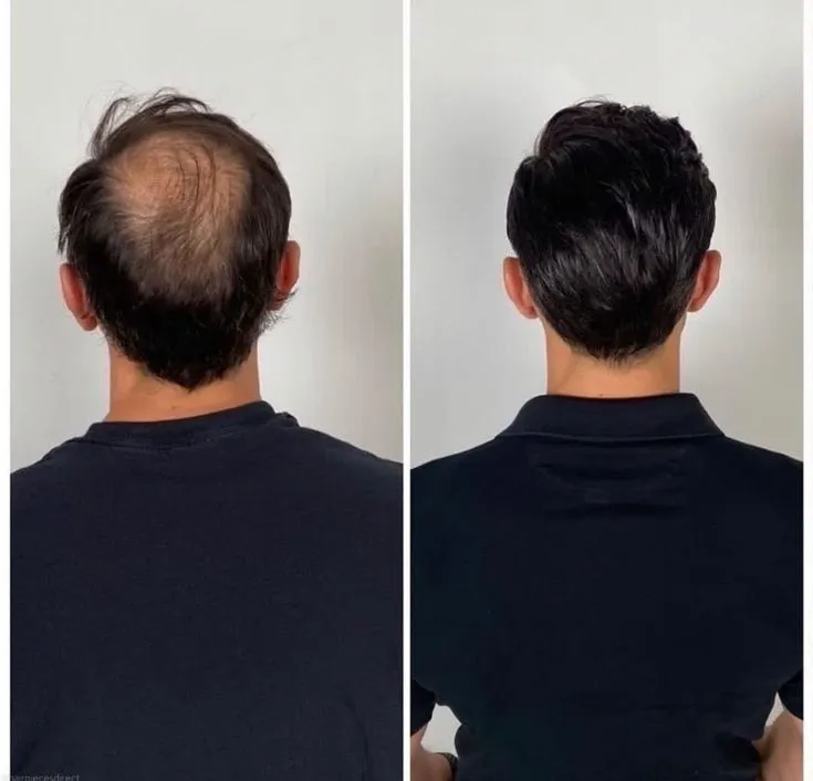 What Is Hair Restoration